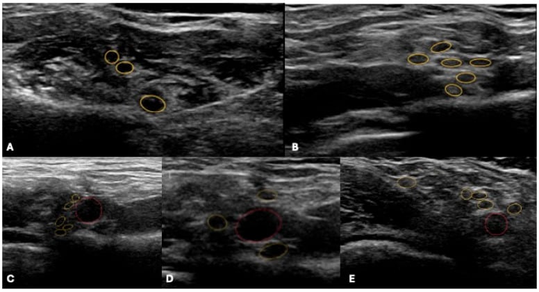 Five-panel ultrasound atlas showing brachial plexus trunks, divisions and cords at successive anatomical levels