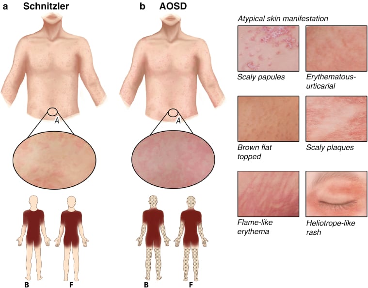 Illustrated schematic of the salmon-pink macular rash of adult-onset Still's disease and its trunk/proximal-limb distribution