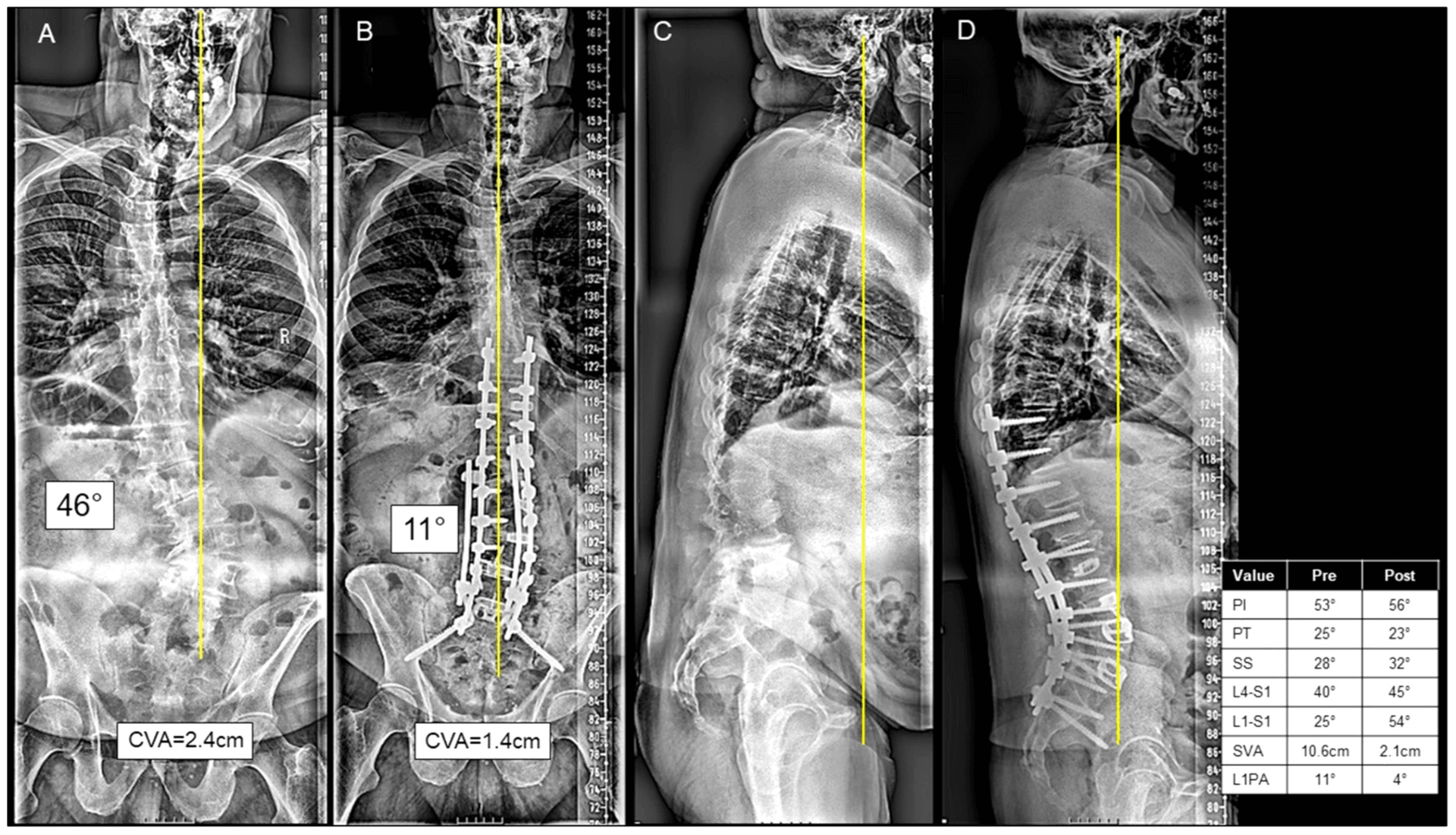 Preoperative and postoperative full-length adult spinal deformity radiographs with coronal and sagittal alignment lines