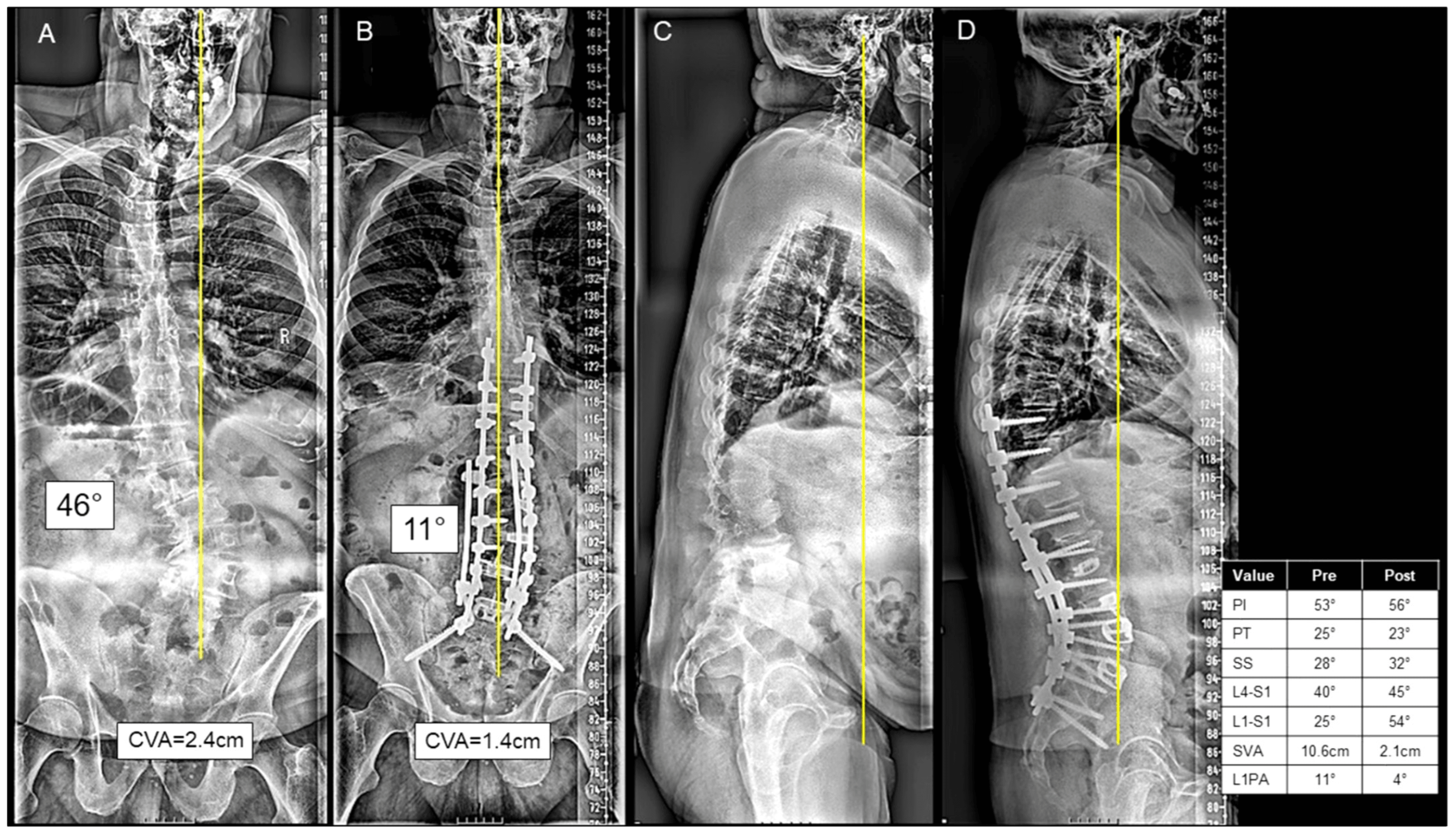 Four-panel pre and postoperative full-length adult spinal deformity radiographs: coronal and sagittal views with measured alignment parameters