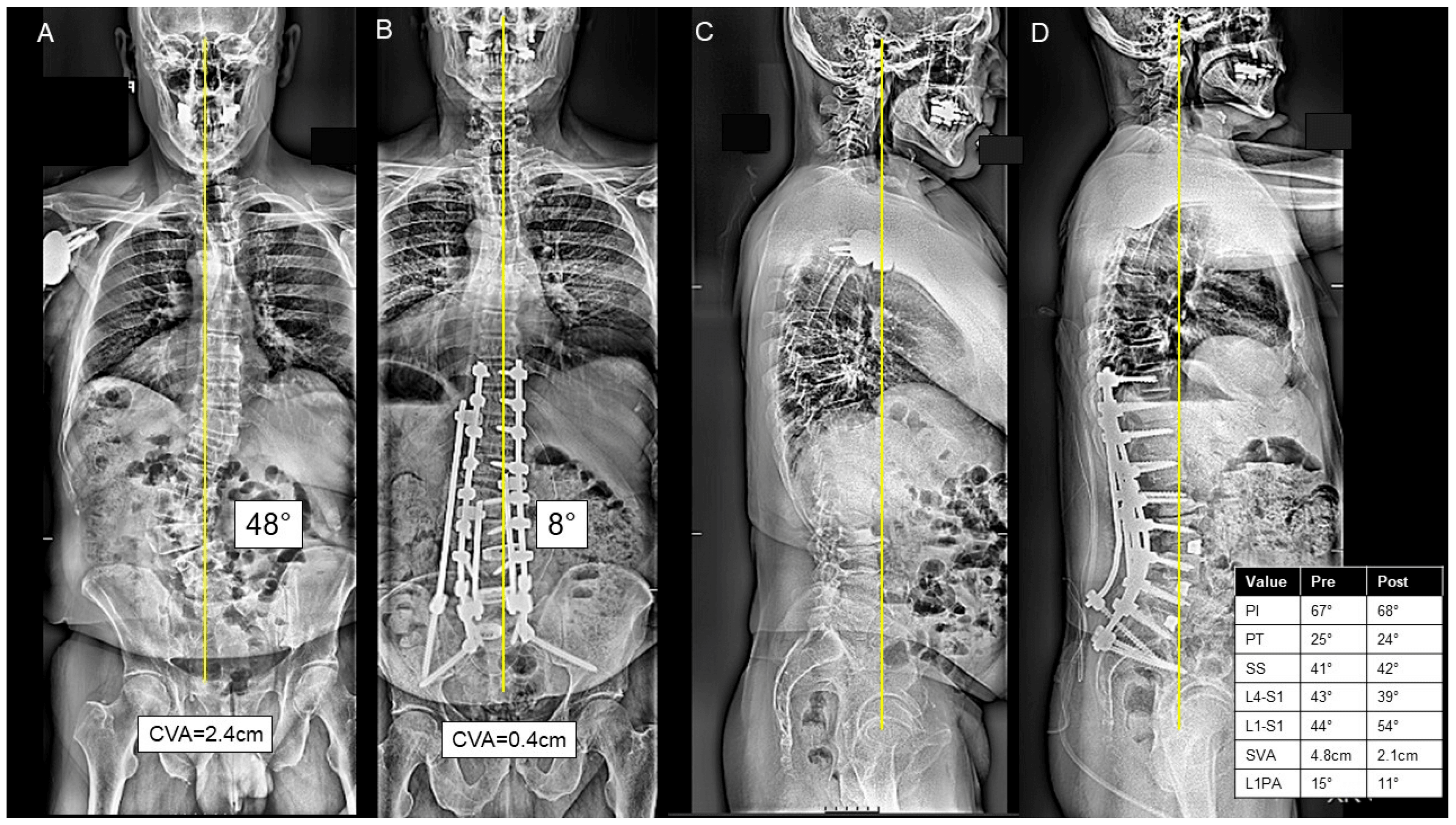 Four-panel pre and postoperative adult spinal deformity radiographs showing coronal curve correction and sagittal realignment