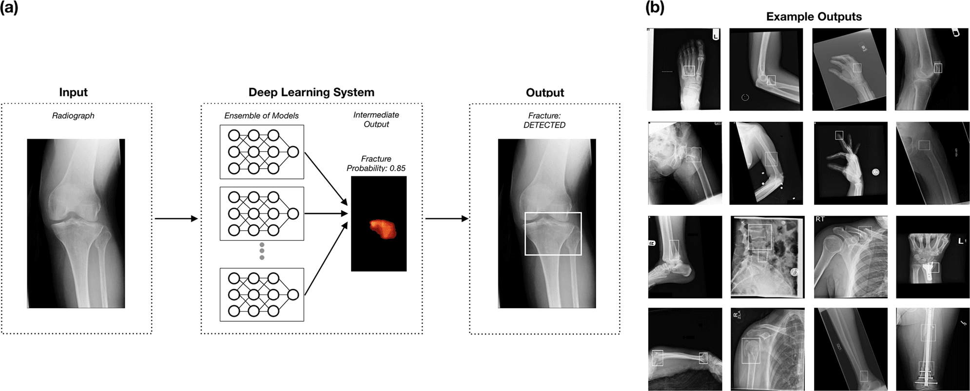 Deep learning fracture-detection workflow and example orthopaedic radiograph outputs
