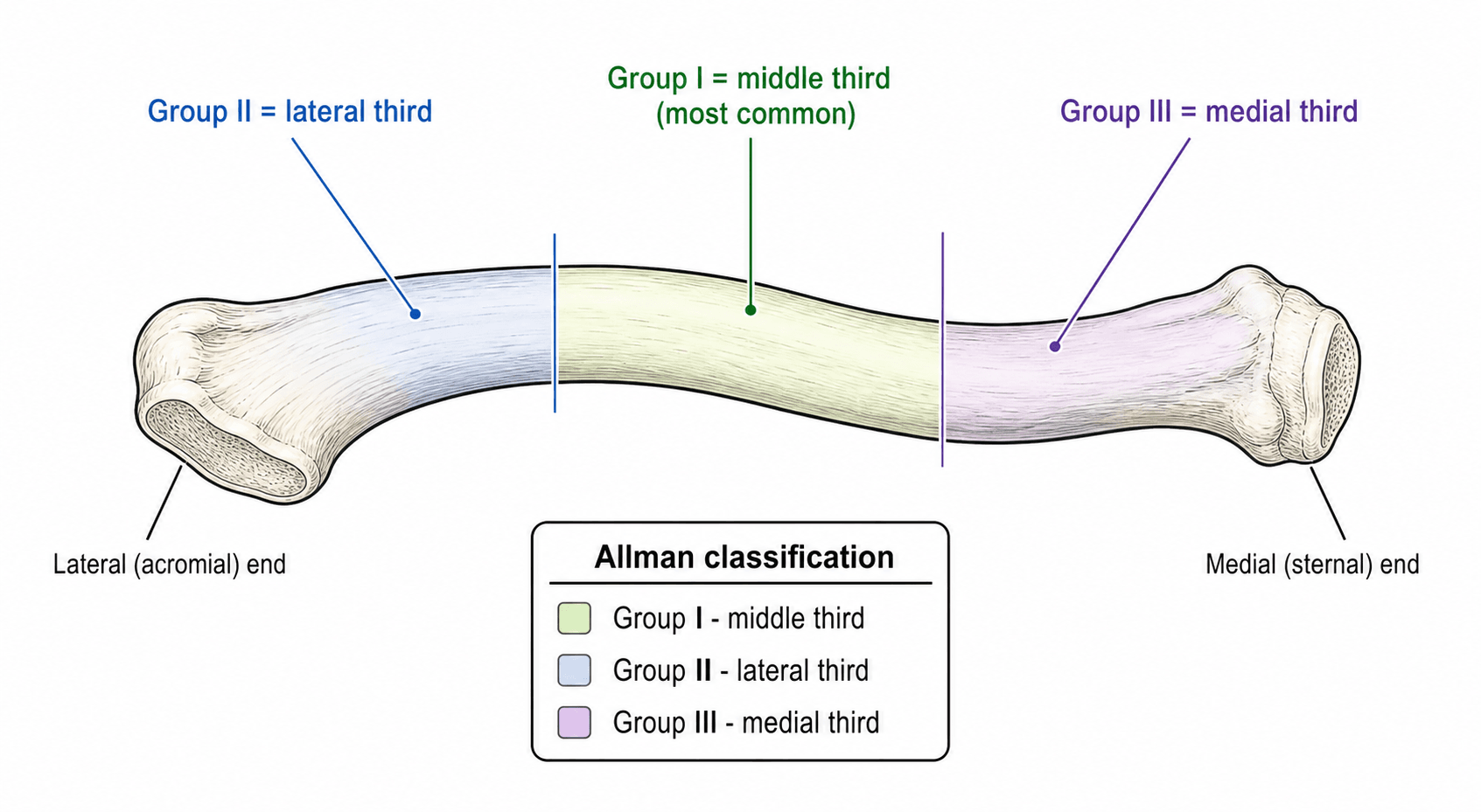Allman classification of clavicle fractures: Group I middle third, Group II lateral third, Group III medial third, shown on a superior view of the clavicle