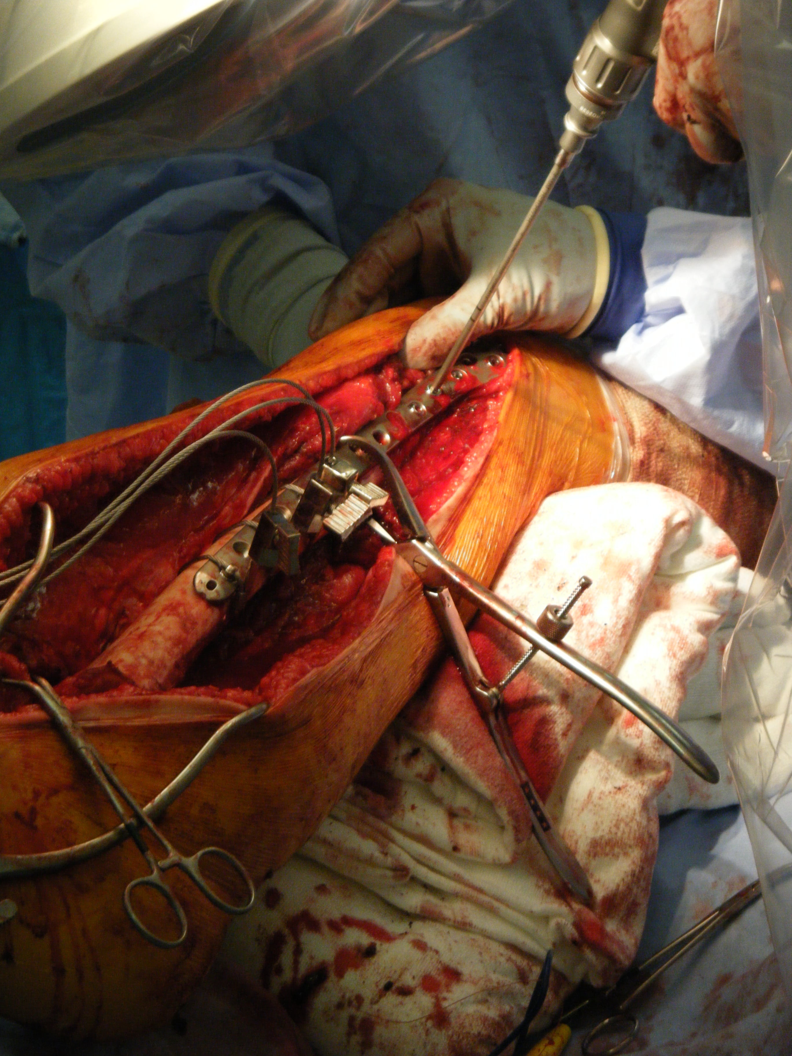 Intraoperative photograph of a bone allograft fixed to the lower femur with screws and cables.