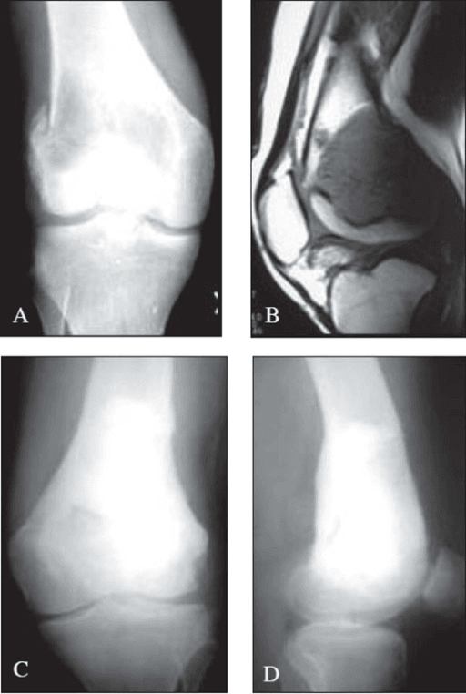 Knee radiograph and MRI showing distal femoral giant cell tumour with lateral condyle pathological fracture.