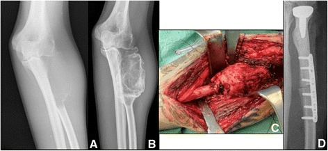 Radiographs before and after denosumab plus intraoperative photographs of tumour and allograft-prosthetic composite implantation.