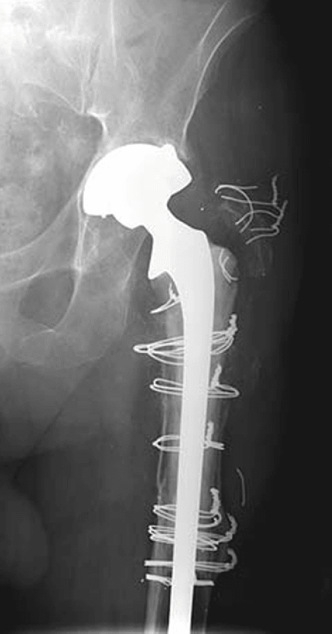 Radiograph of proximal femur with allograft reconstruction 17 years after surgery.