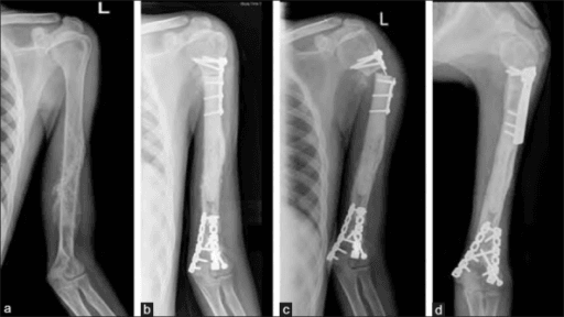 Three humerus radiographs: tumour, postoperative reimplanted bone, and non-union with broken implant.
