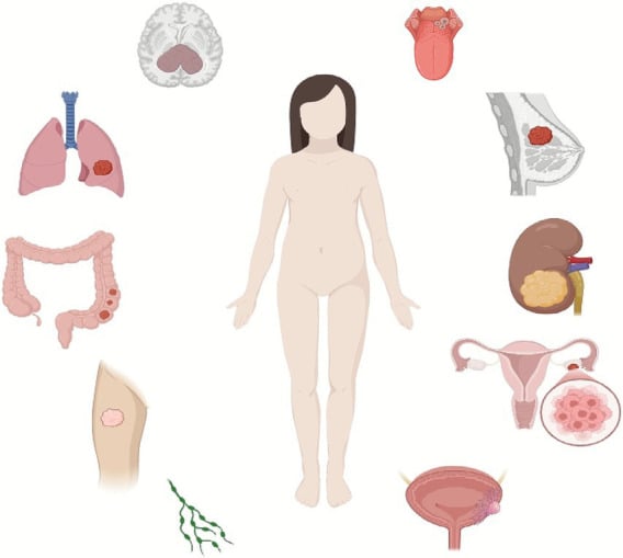 Anatomical distribution diagram of primary tumor sites and metastases in ASPS