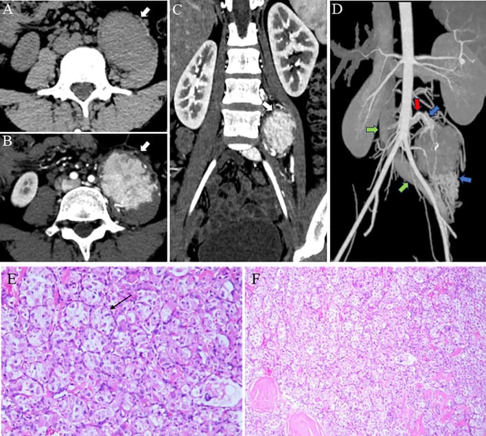 Axial contrast-enhanced CT scan of hypervascular intramuscular ASPS mass