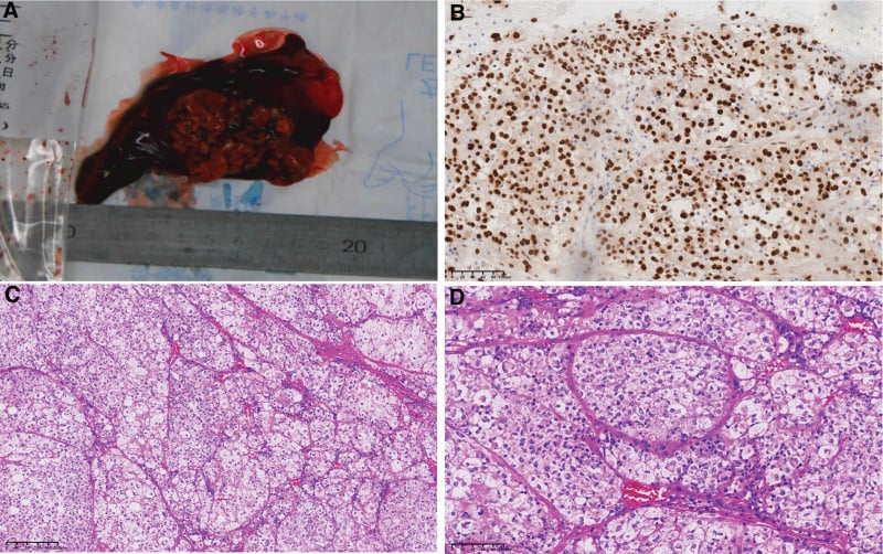Gross specimen, TFE3 immunostain and H&E histology of alveolar soft part sarcoma showing the organoid/alveolar nested pattern