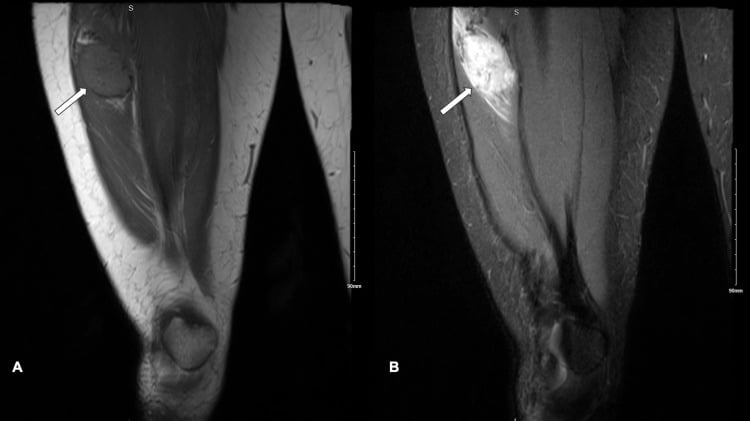 Coronal MRI of the thigh showing a deep intramuscular soft-tissue mass on T1 and T2 sequences