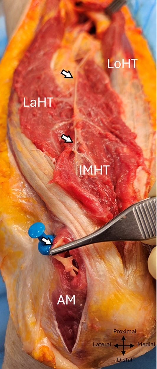 Posterior arm dissection showing the inferomedial radial-nerve branch entering anconeus.