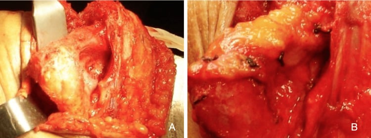 Operative elbow interposition arthroplasty showing distal humeral preparation and an attached autologous dermal graft.