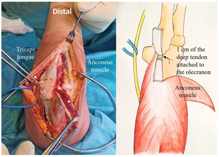 Operative photograph showing anconeus elevated while its neurovascular supply is preserved.