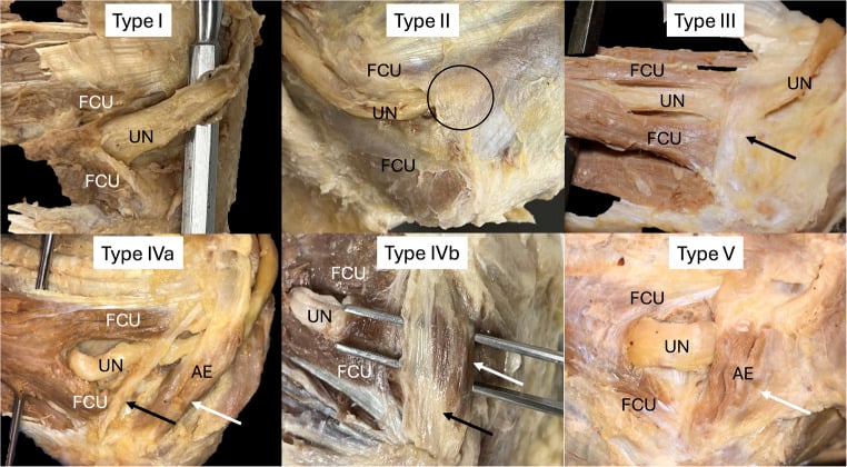 Cadaveric panel classifying Osborne-ligament and anconeus-epitrochlearis variants around the ulnar nerve.