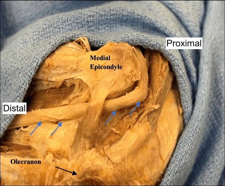Medial elbow cadaveric dissection showing anconeus epitrochlearis crossing superficial to the ulnar nerve.