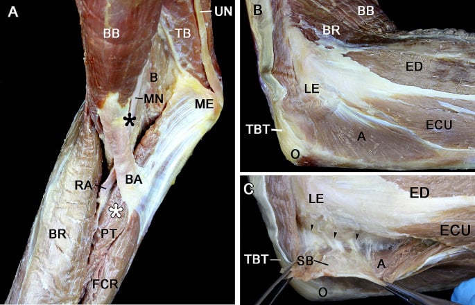 Cadaveric posterolateral elbow dissection showing anconeus and its adherence to the joint capsule.