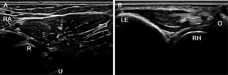 Ultrasound panels including a longitudinal scan of anconeus between the lateral epicondyle and olecranon.