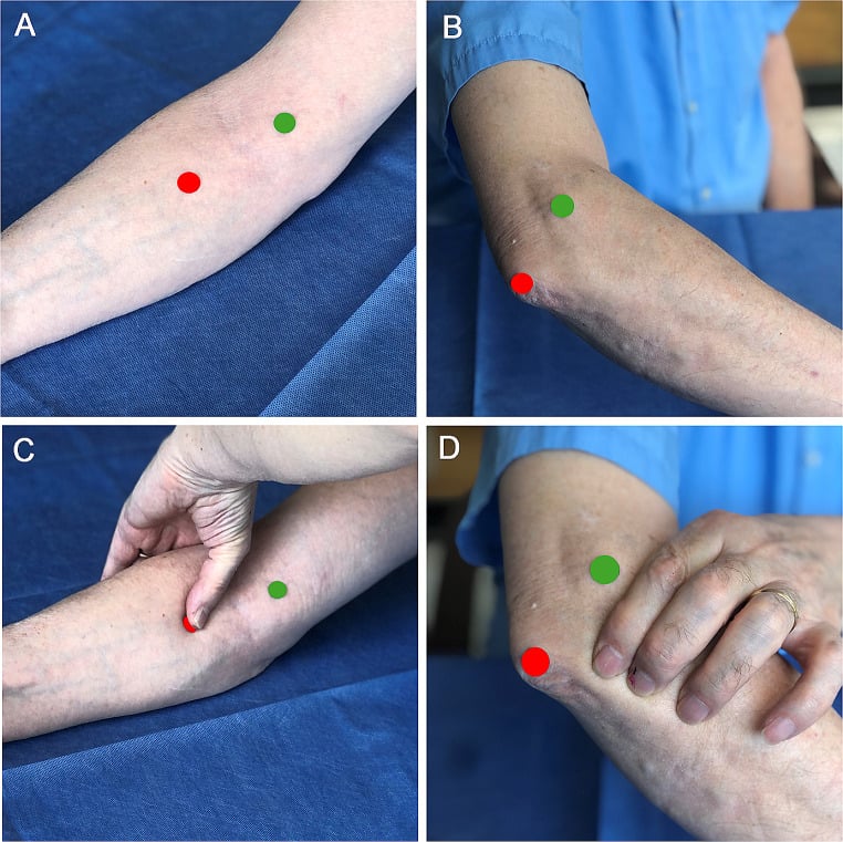 Clinical photographs showing lateral-epicondyle and olecranon landmarks with resisted anconeus palpation.