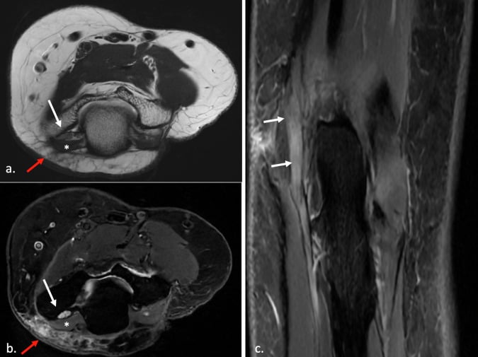 Axial and coronal MRI showing anconeus epitrochlearis over the cubital tunnel with ulnar-nerve enlargement and oedema.