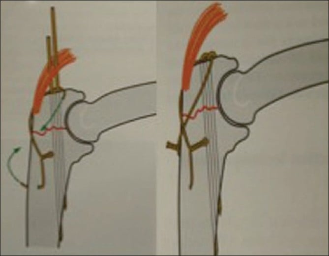 Diagram of olecranon osteotomy exposure and tension-band reconstruction showing the anconeus relationship.