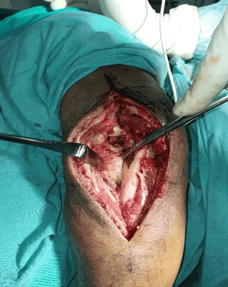 Operative view of the interval along the lateral ulna between anconeus insertion and flexor carpi ulnaris.