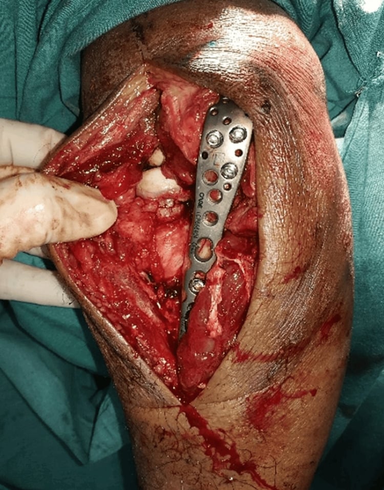 Operative view after the Boyd interval exposes the posterior radial head capsule and annular ligament.