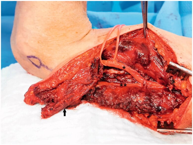 Operative reverse lateral arm flap dissection showing the pedicle and preserved radial and posterior cutaneous nerves.