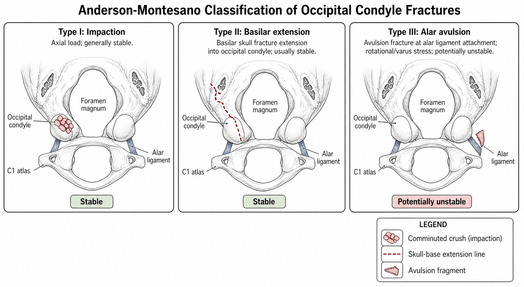 Anderson-Montesano occipital condyle fracture classification: Type I impaction, Type II basilar extension, Type III alar avulsion