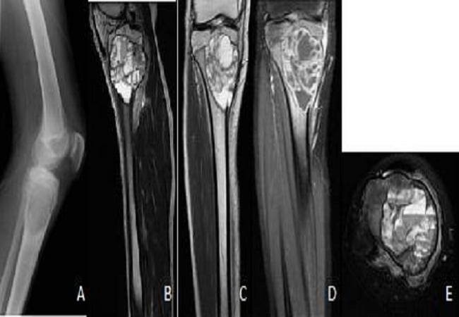 Multimodal imaging of proximal tibial aneurysmal bone cyst