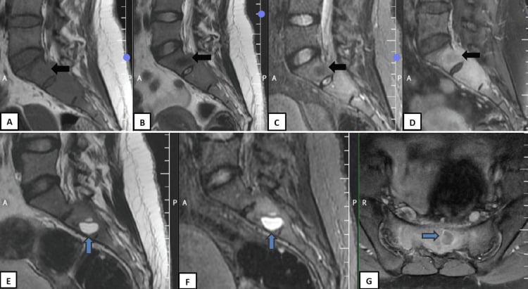 Sagittal and axial MRI panel demonstrating fluid-fluid levels in a spinal aneurysmal bone cyst