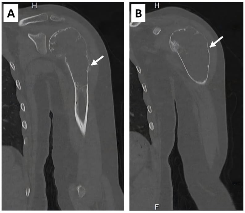 Coronal CT reformations demonstrating an expansile osteolytic lesion of the proximal humerus