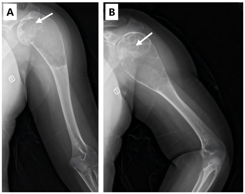 AP and lateral radiographs demonstrating an expansile lytic lesion of the proximal humerus