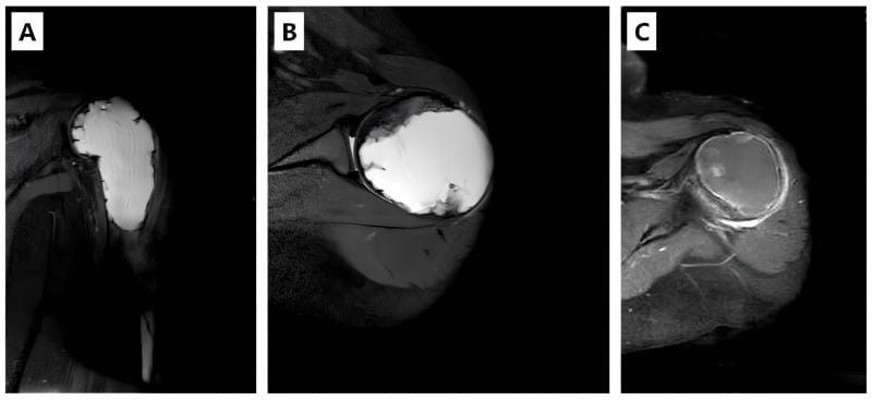 Coronal and axial T2 MRI demonstrating multiloculated fluid-fluid levels in an aneurysmal bone cyst