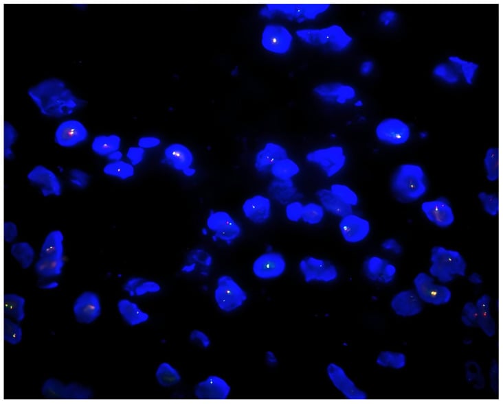 USP6 break-apart FISH fluorescence microscopy demonstrating 17p13 gene rearrangement