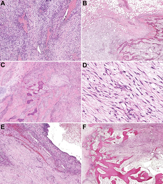 H&E histology section showing cavernous blood spaces and osteoclast giant cells in an aneurysmal bone cyst