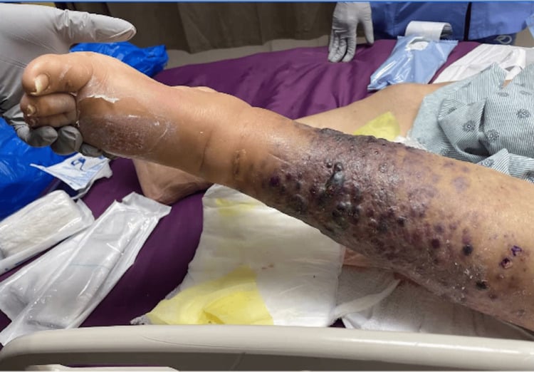 Left lower limb with multiple violaceous and erythematous tense nodules and plaques on a swollen leg