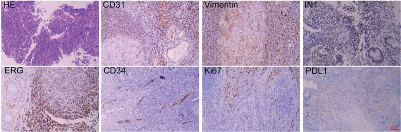 Histopathology with CD31, vimentin, INI1, ERG, CD34, Ki-67 and PD-L1 immunohistochemistry