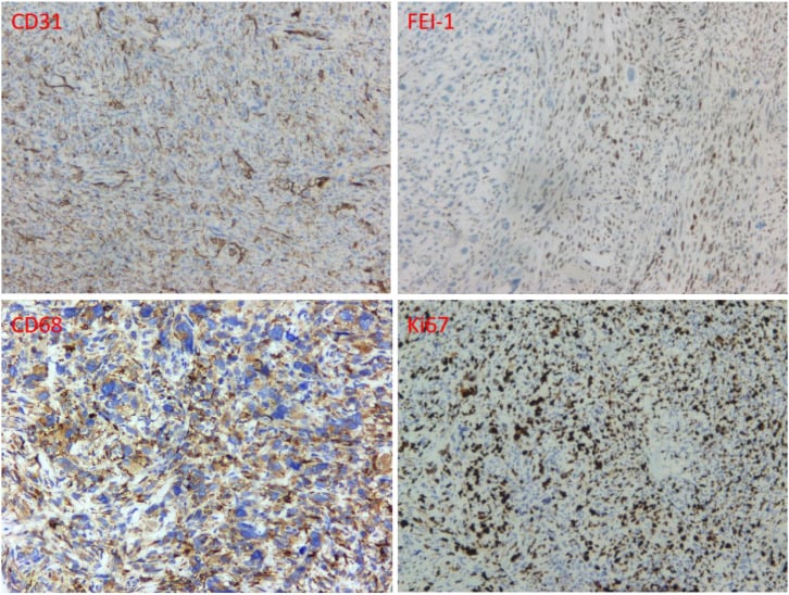 Immunohistochemistry panel showing CD31, FLI-1, ERG and Ki-67 staining in angiosarcoma