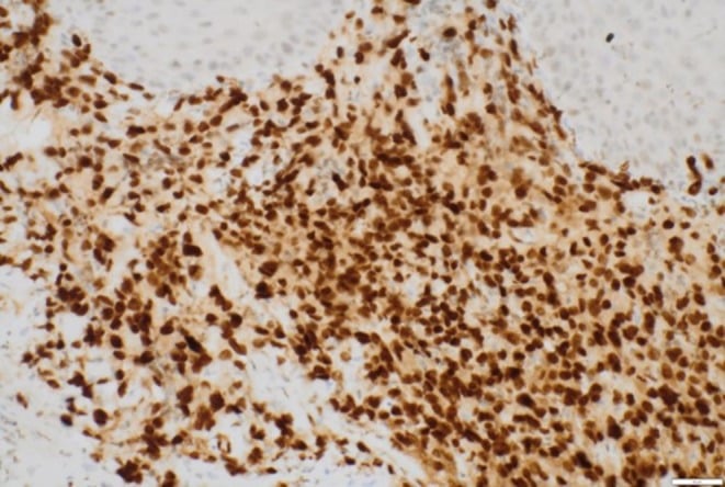 Photomicrograph showing strong diffuse nuclear ERG immunoreactivity in neoplastic cells