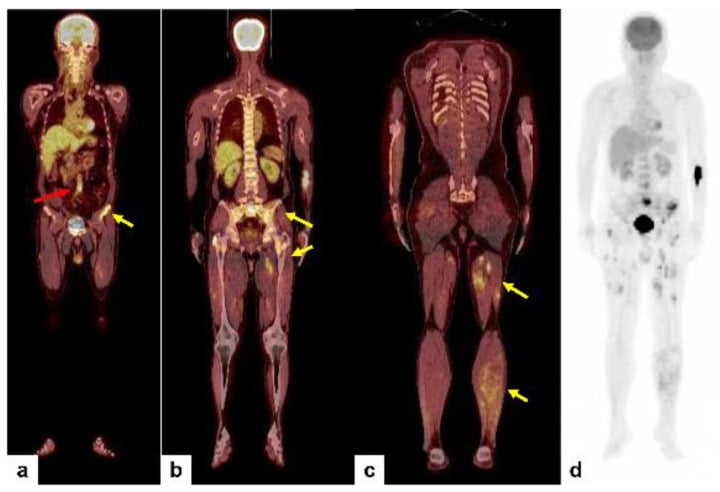 FDG PET/CT showing multiple foci of increased uptake in the femur, sacrum, iliac wing and thigh musculature with maximum intensity projection