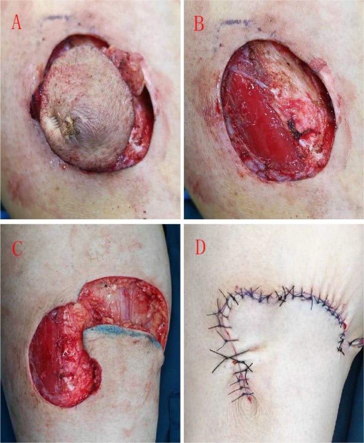 Intraoperative sequence of complete tumour resection from the calf, the defect with exposed tibia, rotation flap design and closure