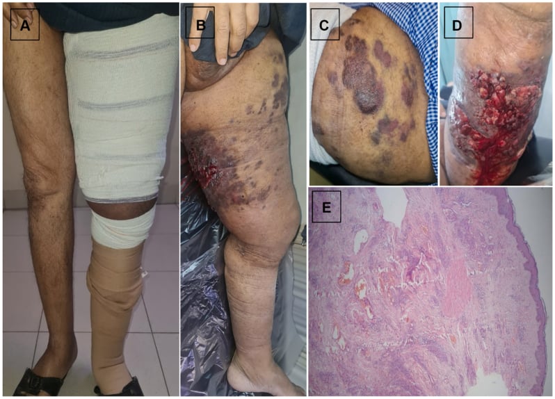 Chronic lymphoedematous lower limb with violaceous thigh plaques and an ulcerated bleeding papillomatous lesion with histology