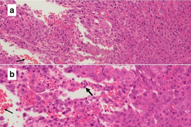 Photomicrograph of malignant epithelioid cells forming irregular vascular channels with extravasated red cells and hobnail nuclei
