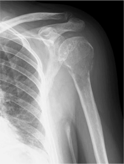 Anteroposterior radiograph of the left shoulder showing a destructive osteolytic lesion of the proximal humerus from angiosarcoma of bone.
