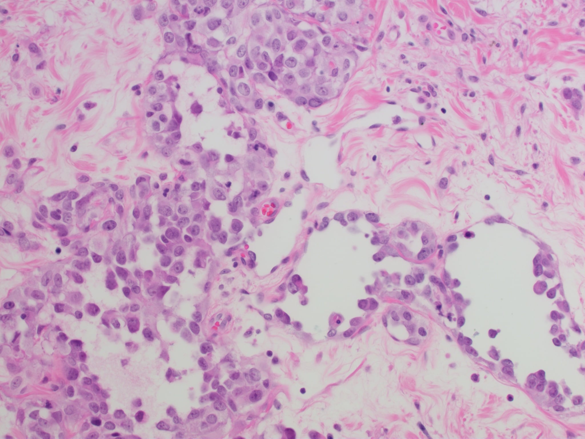 H&E histology of angiosarcoma showing anastomosing vascular channels lined by atypical endothelial cells
