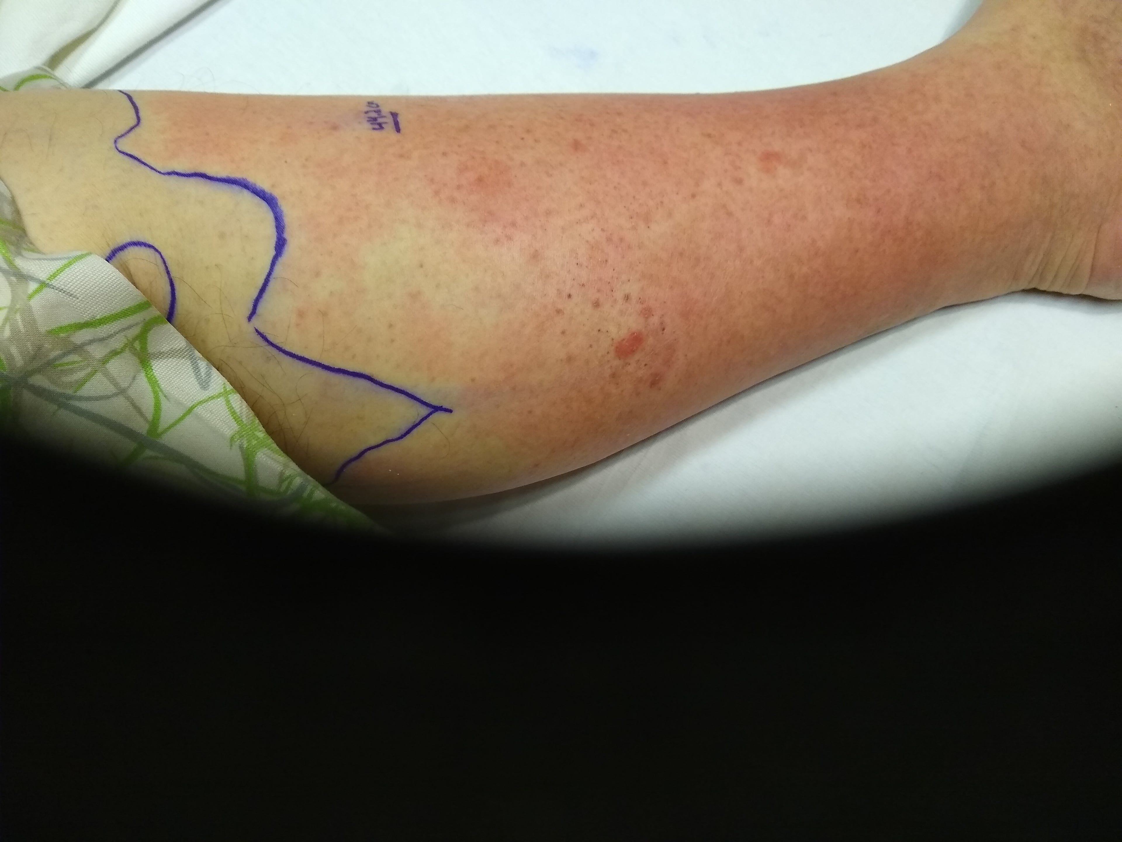 Clinical photograph of a lower leg with erythematous cellulitis, the advancing margin outlined with a skin marker.