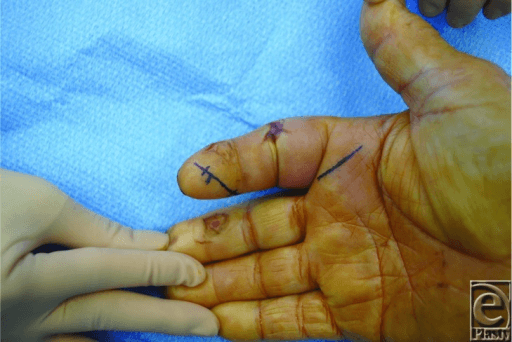 Clinical photograph of a palm marked for proximal and distal closed flexor tendon-sheath irrigation.