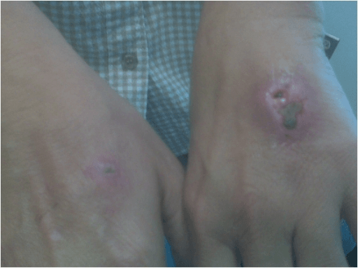 Clinical photograph of bilateral dorsal hand ulcers following dog bites, with a larger nodular eschar-forming lesion on the left.